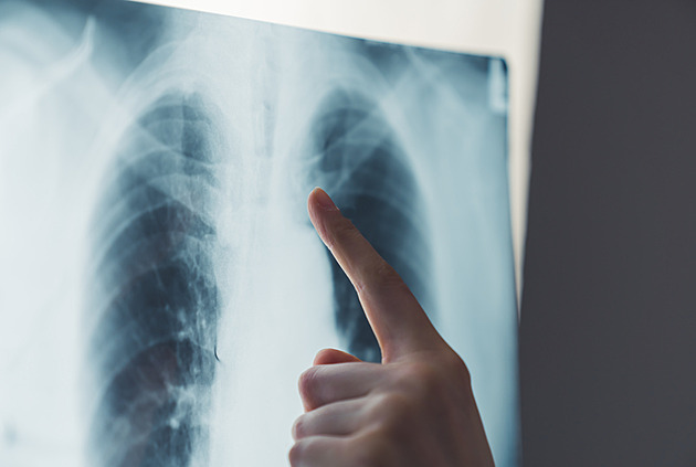 Rakovina plic zabije 85 procent pacientů, umírá stále více žen. Klíčový je screening